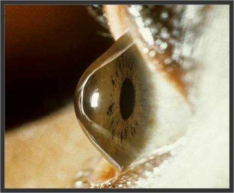 Keratoconus (right) showing anterior protrusion of the cornea.